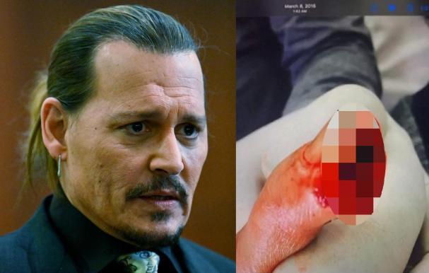 La lesión que Depp mostró en el jucio.