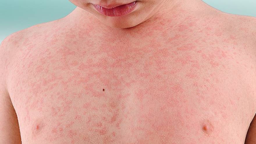 La alergia a la penicilina es una afección a tener en cuenta