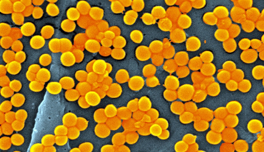 Preocupación en la comunidad médica mundial por el avance de la súper gonorrea, una cepa de esta conocida enfermedad de transmisión sexual (ITS) que se reveló resistente a los antibióticos