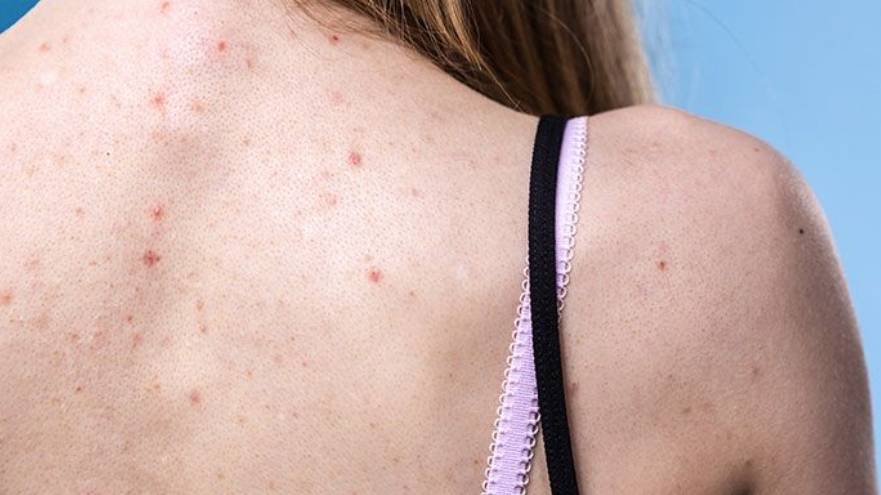 El acné puede aparecer en otras zonas del cuerpo, además del rostro