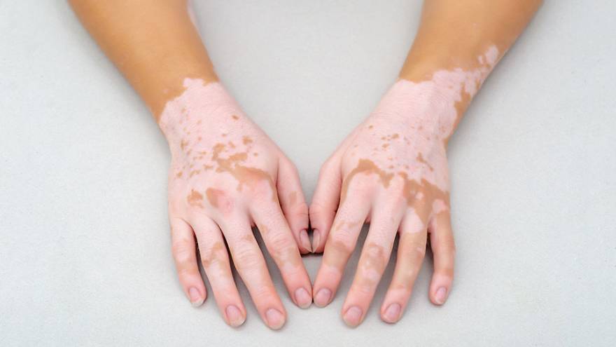 El vitiligo es otra de las causas de la aparición de manchas blancas en la piel