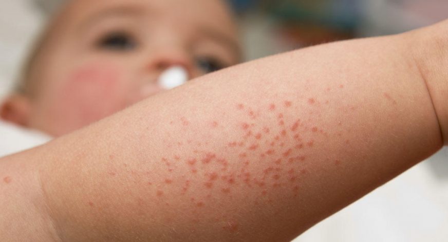 ErupcionMeningitis